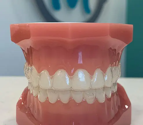 Photo of braces impression