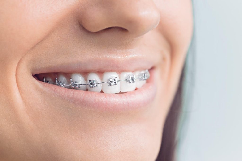 Closeup of the mouth of a celebrity who had braces as an adult