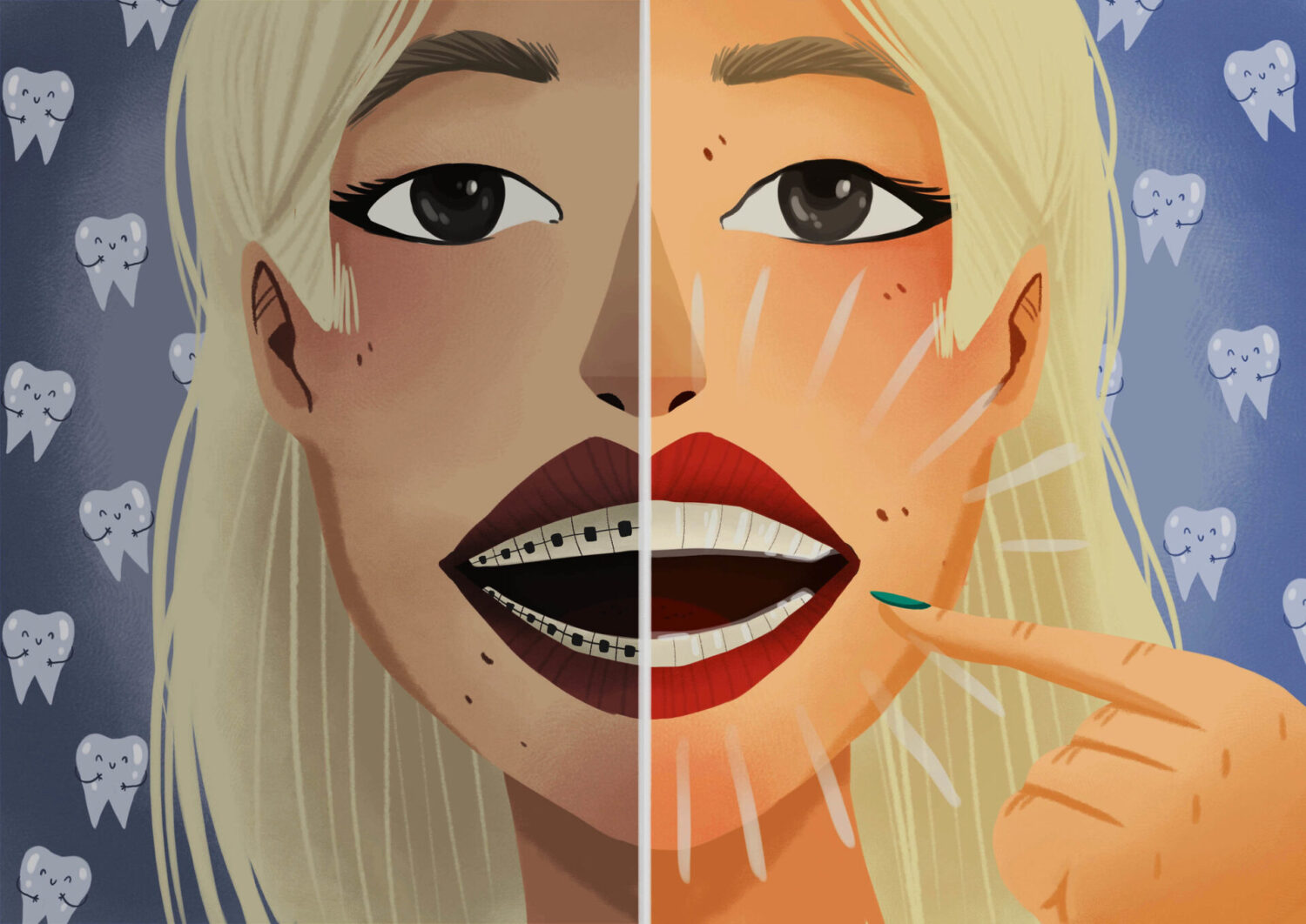 Illustration of a blonde woman with Invisalign on half her smile to compare with braces