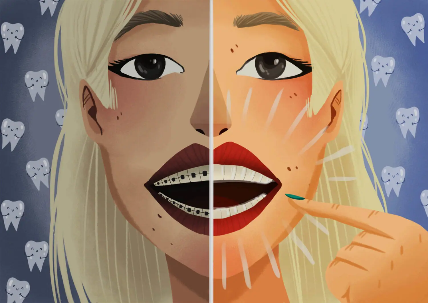 Illustration of a blonde woman with Invisalign on half her smile to compare with braces