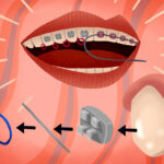 How do braces work?