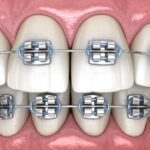 broken brackets, orthodontic care, braces care, Meason Orthodontics, Weatherford TX, orthodontic tips, protect braces, avoid broken brackets, weatherford orthodontist