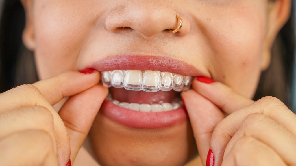 Benefits of Choosing In-House Aligners